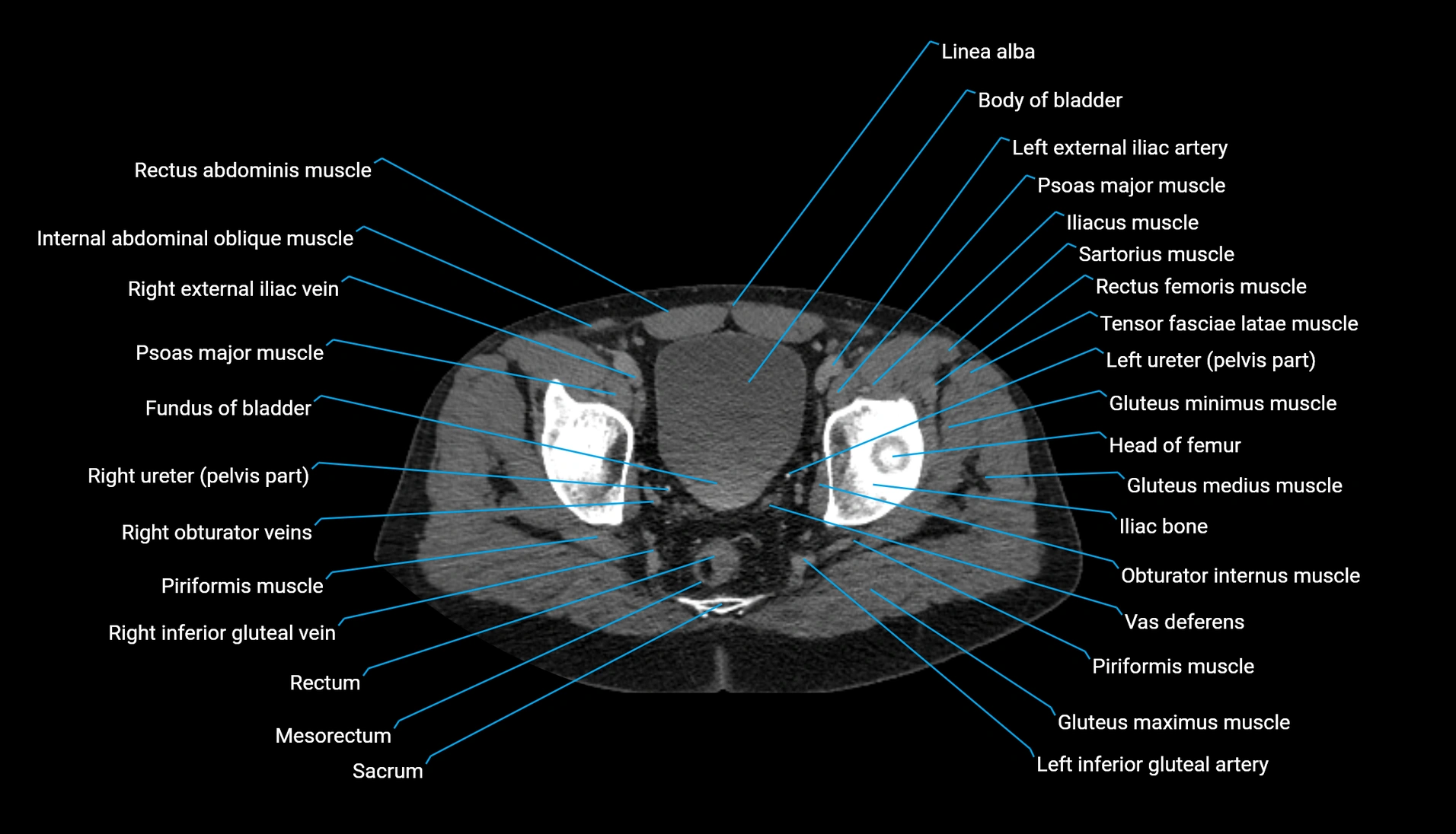 CT urogram axial cross sectional anatomy  labelled radiology image-00222.webp